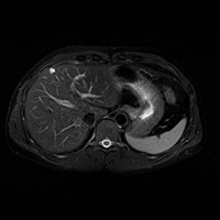 肝臓のMR画像