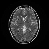 脳のMR画像